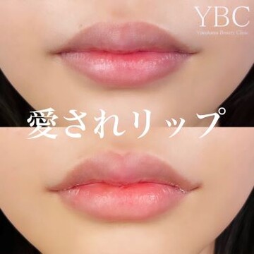 YBC横浜美容外科 大宮院の口元の症例写真