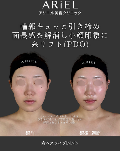 糸リフトの症例写真