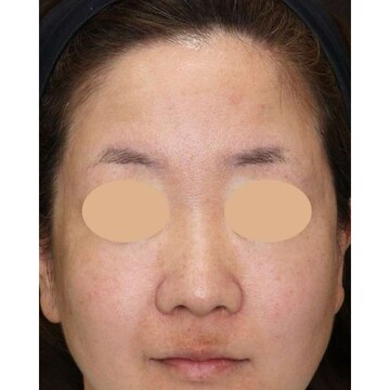 聖心美容クリニックの鼻の症例写真[ビフォー]