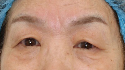 眉下切開+埋没法３点留めの症例写真[ビフォー]