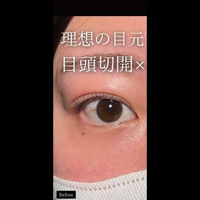 二重埋没法×目頭切開で究極の目元へ☀️の症例写真[ビフォー]