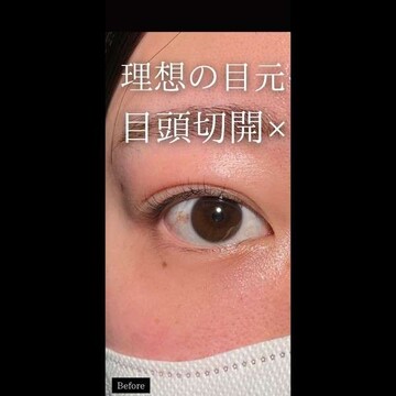 PRISM Beauty Clinicの二重の症例写真[ビフォー]