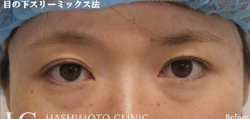静岡美容外科橋本クリニックの目元・クマ・眉下・涙袋整形の症例写真[ビフォー]