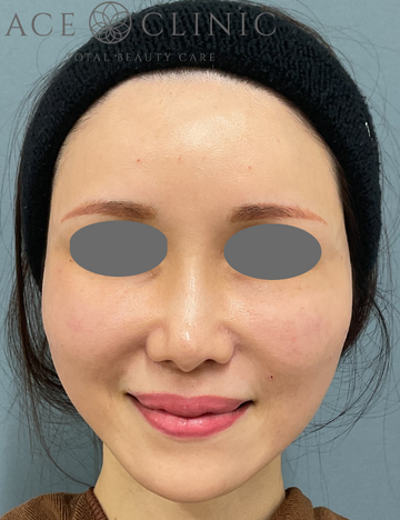 エースクリニックグループのシミ取り・肝斑・毛穴治療の症例写真[ビフォー]