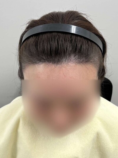 ヘアアートメイク｜30代｜2回の症例写真[アフター]