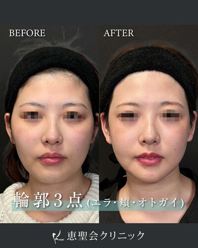 輪郭3点（頬・エラ・オトガイ骨切り）の症例写真