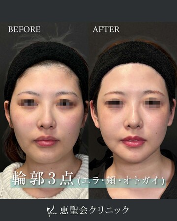 恵聖会クリニック 心斎橋院の輪郭・顎・エラ・額・小顔整形の症例写真