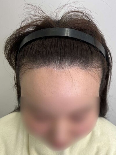 ヘアアートメイク｜30代｜2回の症例写真[ビフォー]