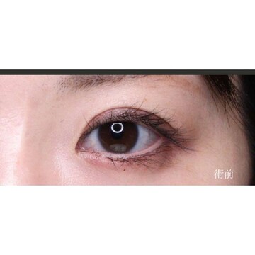 聖心美容クリニックの目元の症例写真[ビフォー]