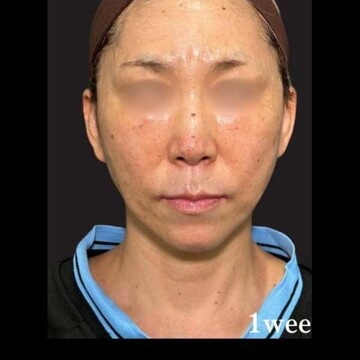 PRISM Beauty Clinicの症例写真[アフター]