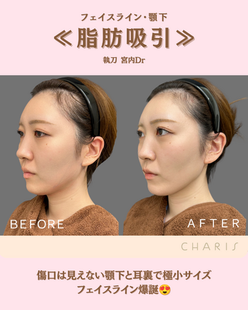 CHARIS BEAUTY CLINICの脂肪吸引の症例写真