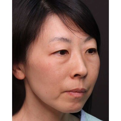 裏ハムラ法で強い目元の影を根本から改善（術後3ヶ月）の症例写真[ビフォー]