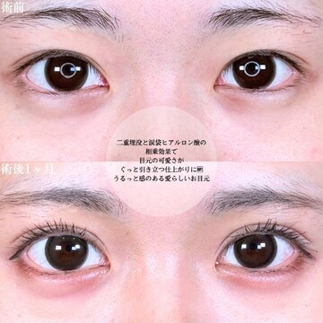 アリエル美容クリニック 大宮院の目・二重整形の症例写真