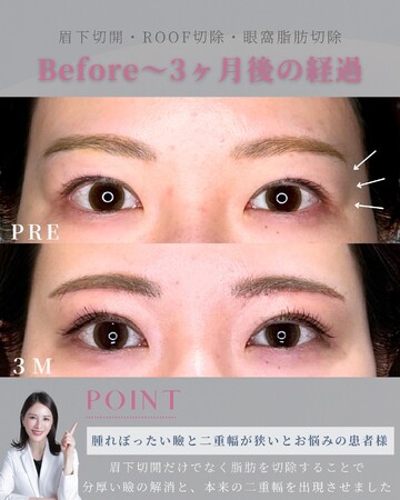 KNOT CLINIC AOYAMAの目元・クマ・眉下・涙袋整形の症例写真