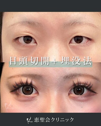 目頭切開（+MT埋没法 3点留め）の症例写真