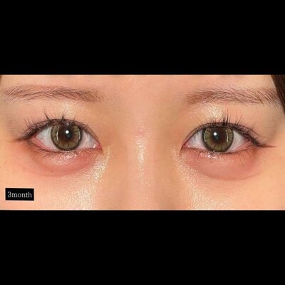 愛らしい目元って？🥺の症例写真[アフター]