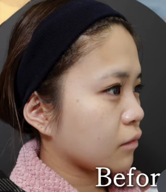 Plume Clinicのしわ・たるみ整形(注入、糸、フェイスリフト)の症例写真[ビフォー]