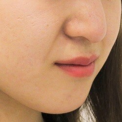 ほうれい線へのヒアルロン酸注入とhifu ハイフ の症例 ほうれい線の整形 ヒアルロン酸注入 シワ たるみ治療 の症例 A Clinic エークリニック Cs303 美容医療の口コミ広場