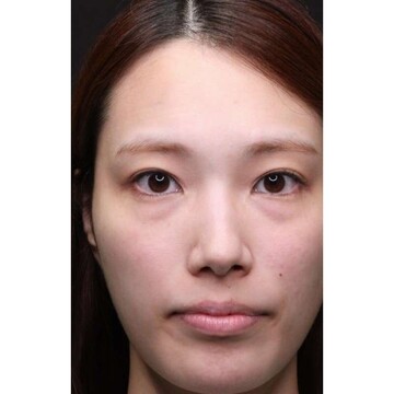 聖心美容クリニックの目元の症例写真[ビフォー]