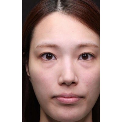 裏ハムラ法の長期経過で自然な目元を維持（術後6ヶ月）の症例写真[ビフォー]