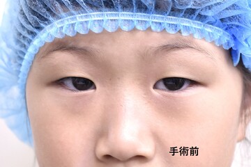医療法人秀晄会 心斎橋コムロ美容外科クリニックの目・二重整形の症例写真[ビフォー]