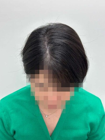 ヘアアートメイク｜40代｜2回の症例写真[アフター]