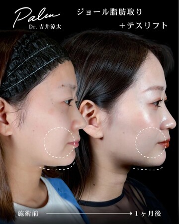 パルム美容クリニックのしわ・たるみ整形(注入、糸、フェイスリフト)の症例写真