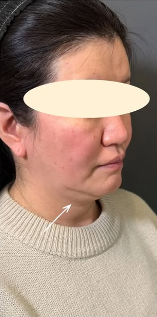 Plume Clinicの脂肪吸引の症例写真[ビフォー]