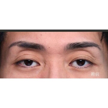 聖心美容クリニックの二重の症例写真[ビフォー]