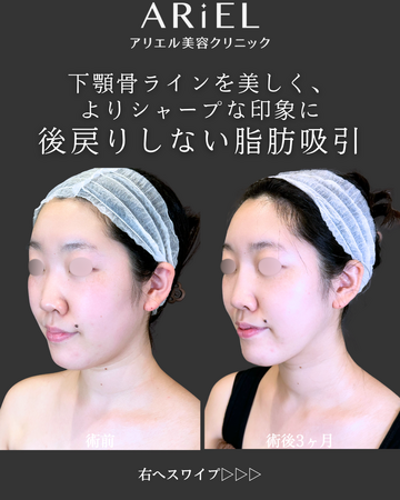 アリエル美容クリニック 郡山院の輪郭・顎・エラ・額・小顔整形の症例写真