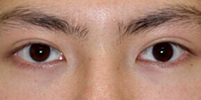 眼瞼下垂術 眼瞼下垂の症例写真 画像 大塚美容形成外科 東京大塚院 Cs 美容医療の口コミ広場