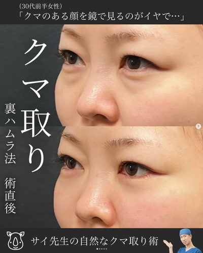 裏ハムラの症例写真