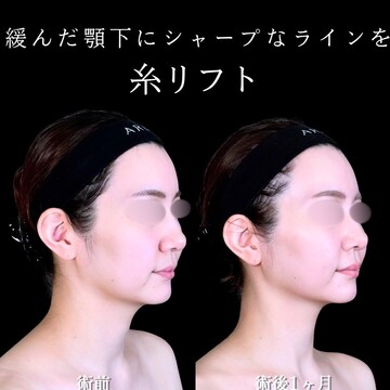 アリエル美容クリニック 大宮院のしわ・たるみ整形(注入、糸、フェイスリフト)の症例写真