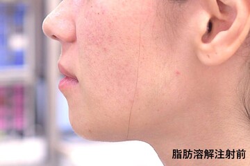 医療法人秀晄会 心斎橋コムロ美容外科クリニックの痩身、メディカルダイエットの症例写真[ビフォー]