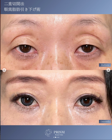 PRISM Beauty Clinicの目・二重整形の症例写真