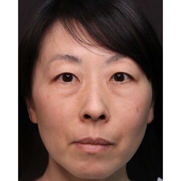 聖心美容クリニックの目元の症例写真[ビフォー]