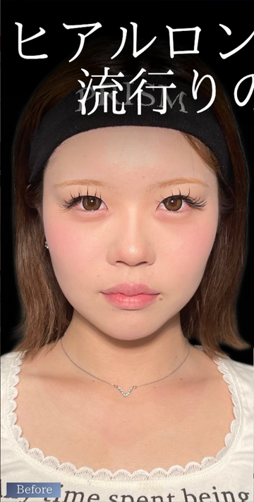 PRISM Beauty Clinicのしわ・たるみ整形(注入、糸、フェイスリフト)の症例写真[ビフォー]