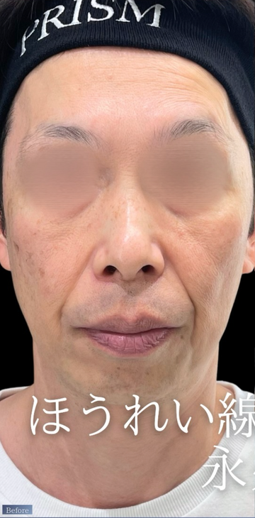 PRISM Beauty Clinicのしわ・たるみ整形(注入、糸、フェイスリフト)の症例写真[ビフォー]