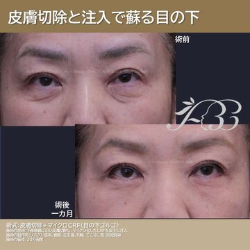 あいちビューティークリニック栄本院の目元・クマ・眉下・涙袋整形の症例写真