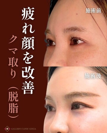 ギャラリークリニックの目元・クマ・眉下・涙袋整形の症例写真