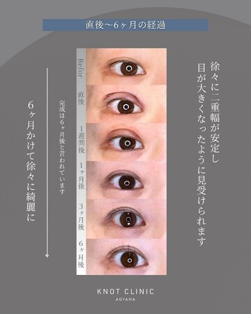KNOT CLINIC AOYAMAの二重の症例写真