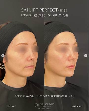 SAI CLINIC （サイクリニック）のリフトアップの症例写真