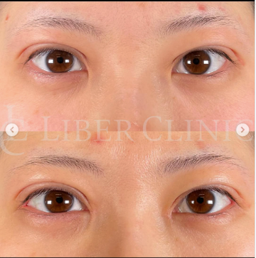 LIBER CLINIC （リベルクリニック）の目・二重整形の症例写真