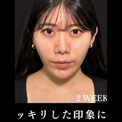 アルテミスリフト10本の症例写真[アフター]