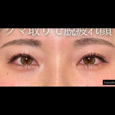 クマ取りとヒアルで目元を若返る⭐️の症例写真[アフター]