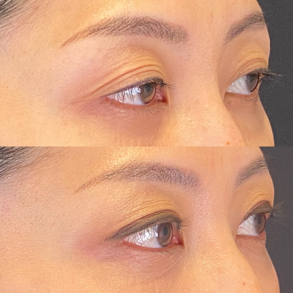 30代 女性] 目のくぼみの改善、全切開二重術とナノリッチ 術前と1ヶ月後（目・二重整形）の症例写真 (CS70498)｜SOL CLINIC（ソル クリニック）《美容医療の口コミ広場》