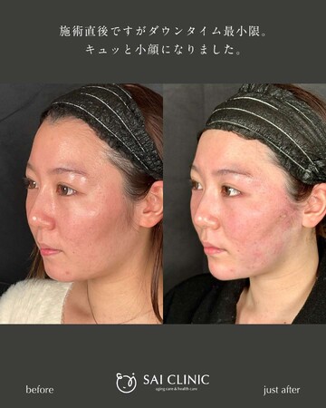 SAI CLINIC （サイクリニック）のリフトアップの症例写真