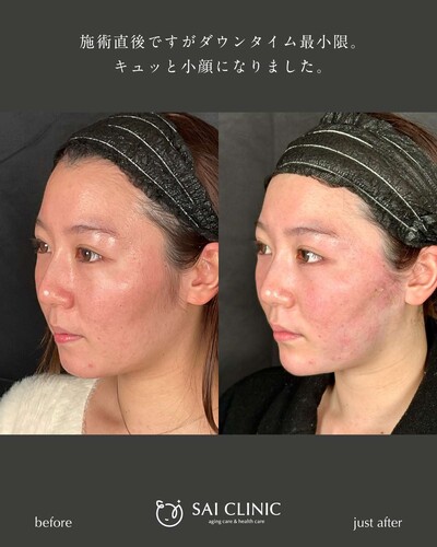 糸リフト：10本の症例写真