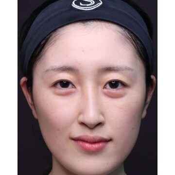 聖心美容クリニックの二重の症例写真[ビフォー]
