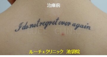 タトゥー除去 口コミ1742件 美容外科308院 美容医療の口コミ広場